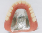 金属の総入れ歯