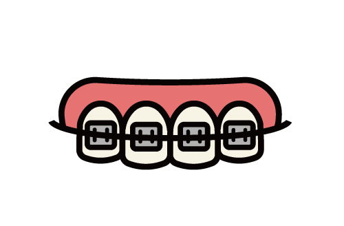 歯科矯正のイラスト
